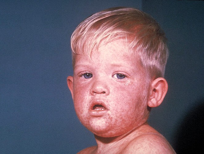 Rubella (German Measles) - KidsHealth