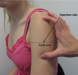 Different injection sites steroids