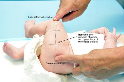 Image of an infant, with notations indicating the lateral femoral condyle and greater trochanter, with an arrow pointing to the injection site.