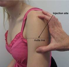 Image of a person's shoulder with the axilla line and injection site notated.