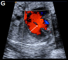 Cardiac anomalies | New Zealand Obstetric Ultrasound Guidelines ...