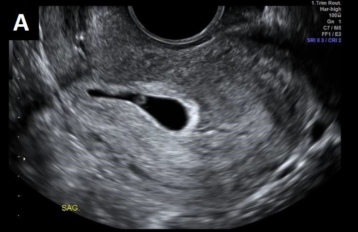 Appendix 2: Low gestational sac in the first trimester ...