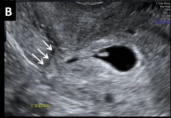 Uterus weeks 6 tilted ultrasound Tilted Uterus