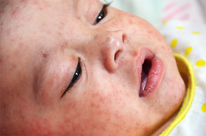 Photo of a baby with the measles rash on its face. 
