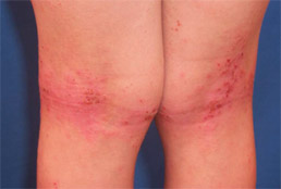 Photo of ezcema behind a child's knees, where the ezcema is very red, with little sores. 