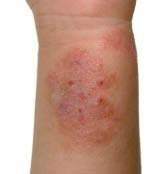 Photo of eczema on a child's wrist, where the eczema is red and scabby. 