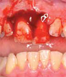 Photo of someone's teeth, where one of the top front teeth has been displaced. It's been pushed backwards and appears to hang lower than the teeth next to it. 