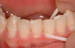 Photo of someone flossing between two teeth, with the floss curved around one tooth to clean along the gumline. 