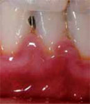 Photo of someone with gingivitis. Their gums are red and inflammed, and you can see plaque around the gumline. 